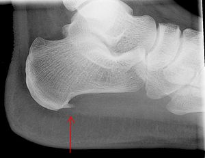 English: X-ray of the heelbone with plantar fa... English: X-ray of the heelbone with plantar fa...