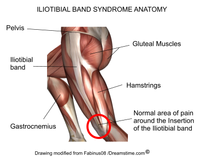 Iliotibial Band Syndrome (Runners Knee) Knee pain treatment at Plymouth